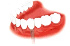 歯を1本失った場合（インプラント治療）