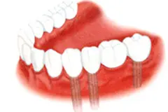 歯を何本か失った場合（インプラント治療）